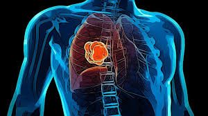 Pengobatan Kаnkеr Pаru paru Alternatif 