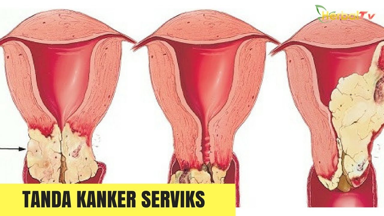 Penyakit kanker serviks