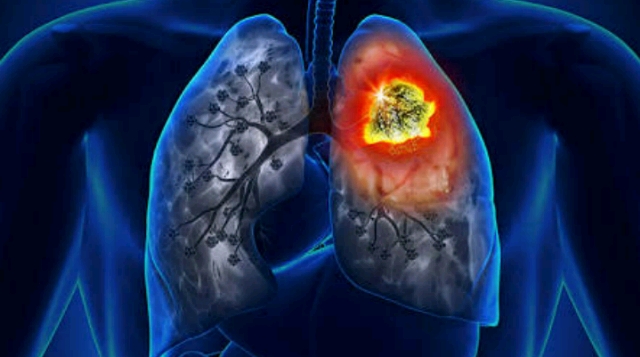 Penyakit kanker paru paru